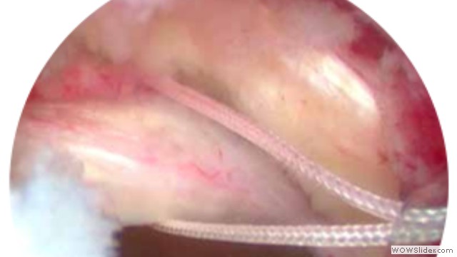 Artroscopia de Cadera