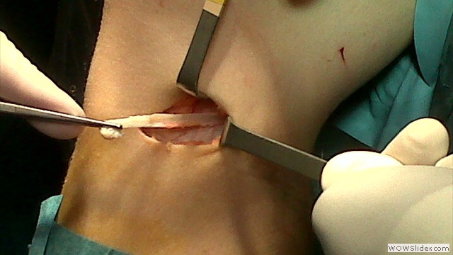 Plastia LCA